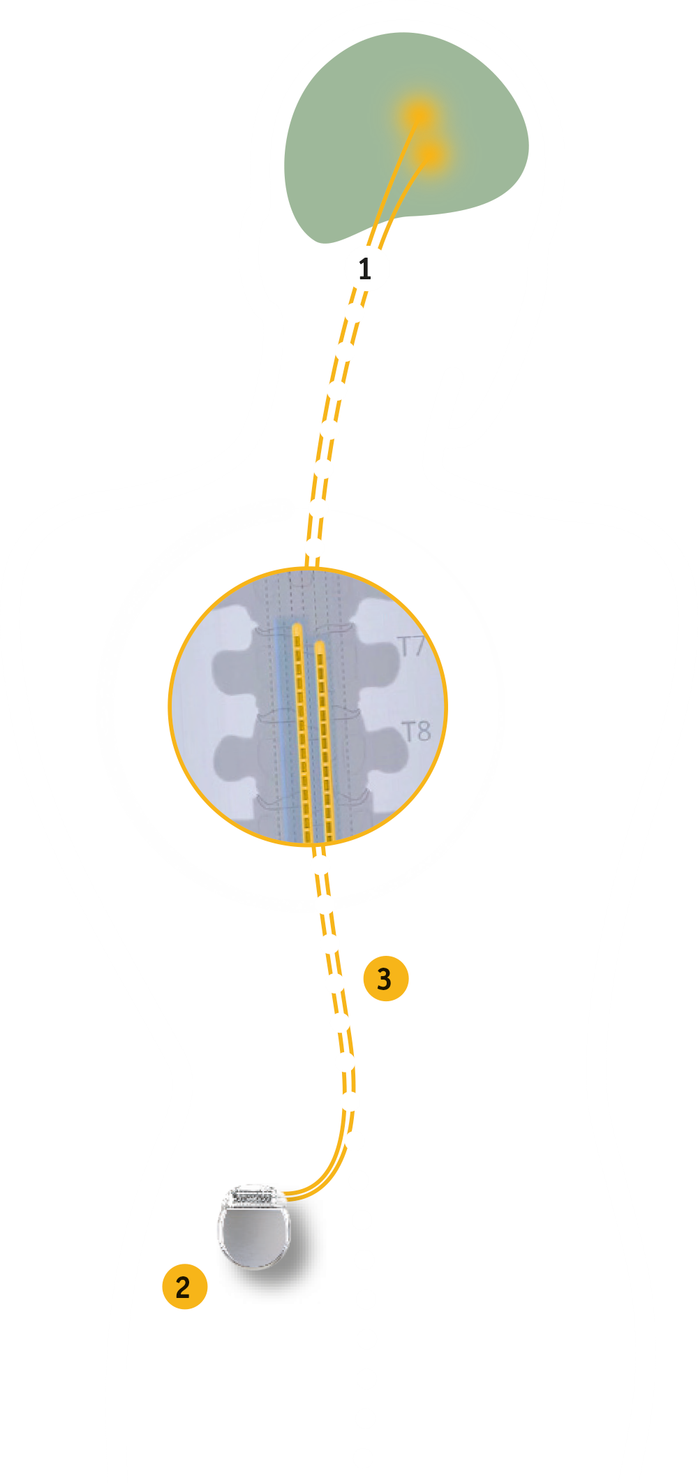 Existing educational illustration of spinal cord stimulation placement